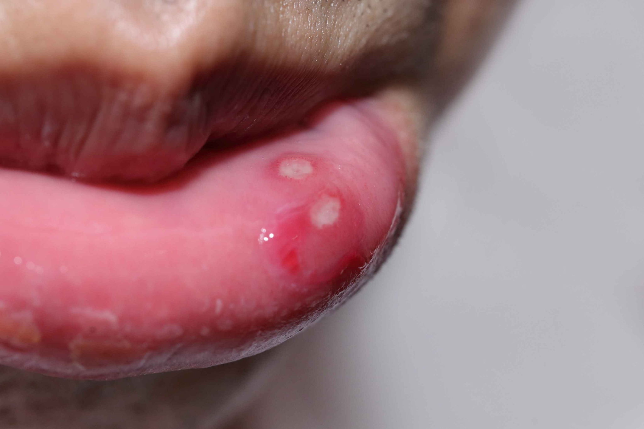 舌乳头炎治疗图片
