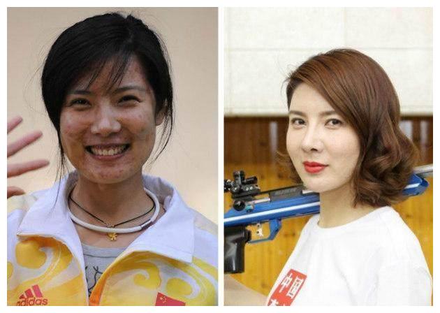 杜丽是所有运动员中越变越好的例子,在运动期间她就因为满脸的痘痘