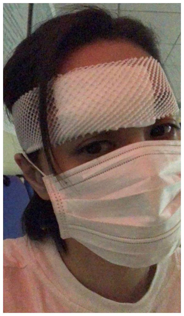 阿娇头伤入院照曝光右边近眉6cm伤口缝数十针