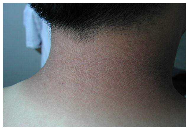 就问医生会出什么样的事情,那位医生说孩子得了假性黑棘皮病,其实