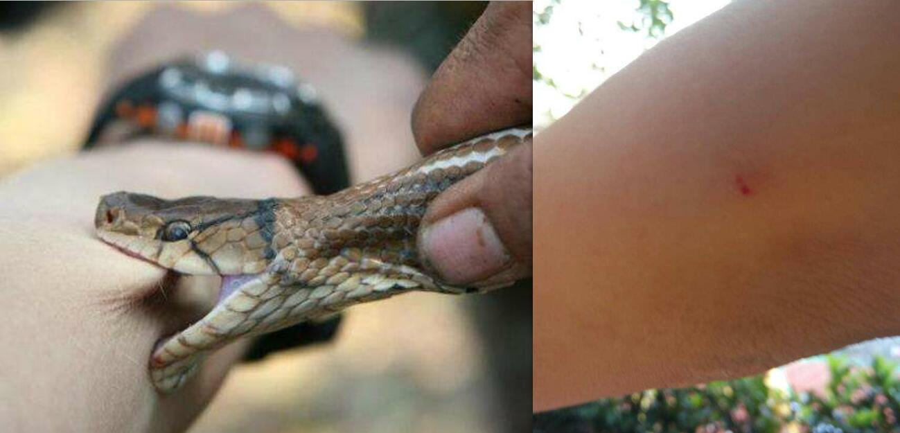 男子注射百种毒蛇液获免疫力只为帮助贫困国家受毒蛇威胁的人