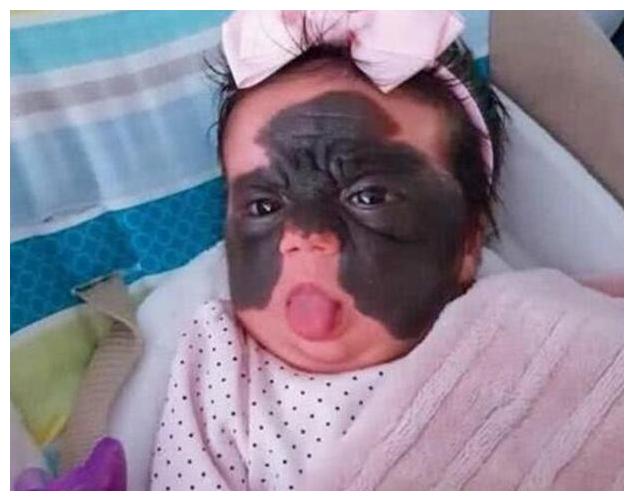 由于这个小女孩脸上的胎记非常对称,既看着像一只蝴蝶落在了他的脸上