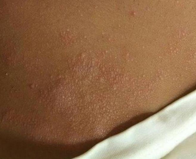 难以启齿的痒,小心硬化性苔藓|苔藓|硬化性|皮肤_新浪新闻