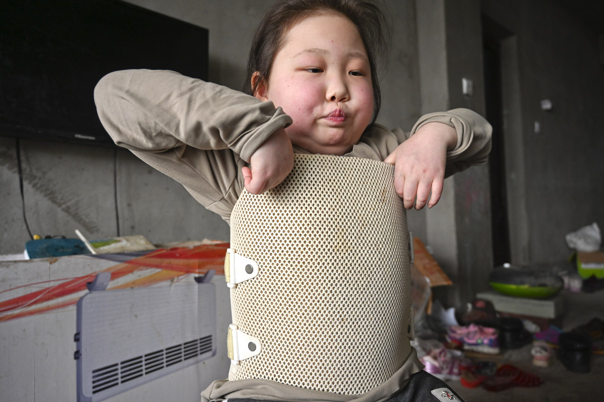 河南女孩因免疫系统缺陷患怪病,每天穿厚重"盔甲",称疼死了|王庆玲