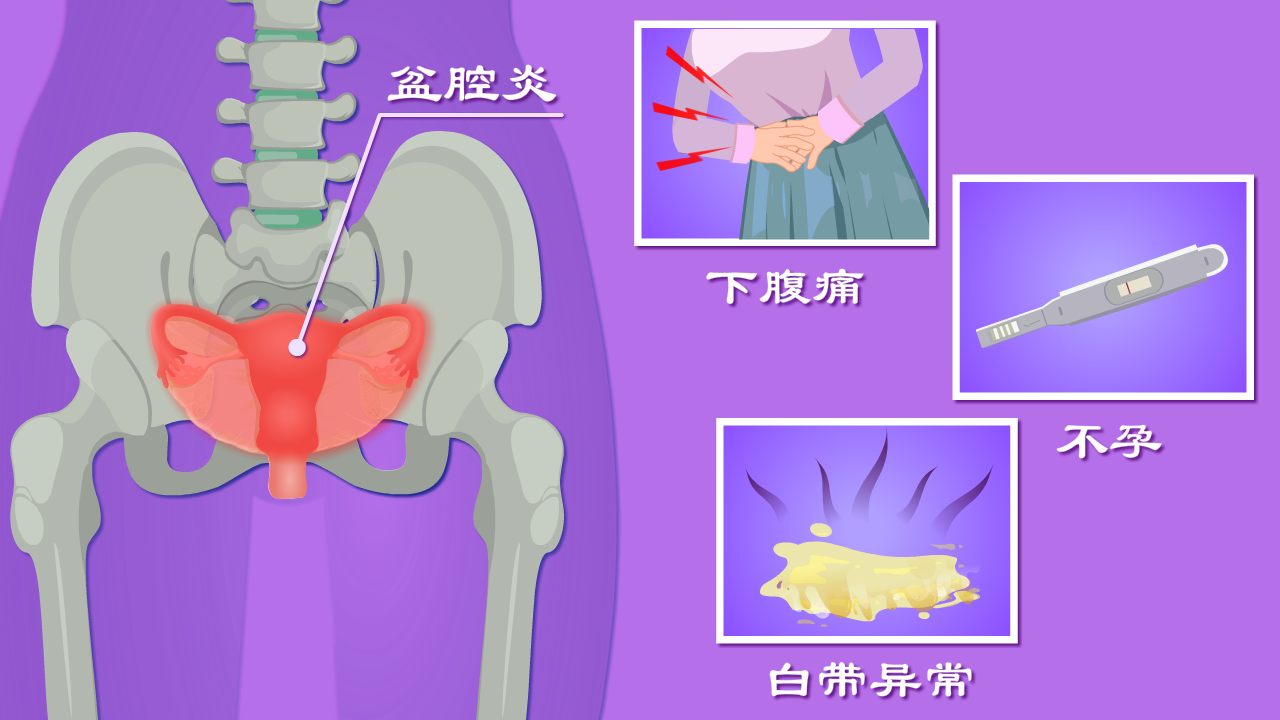 盆腔炎图片是什么样子图片