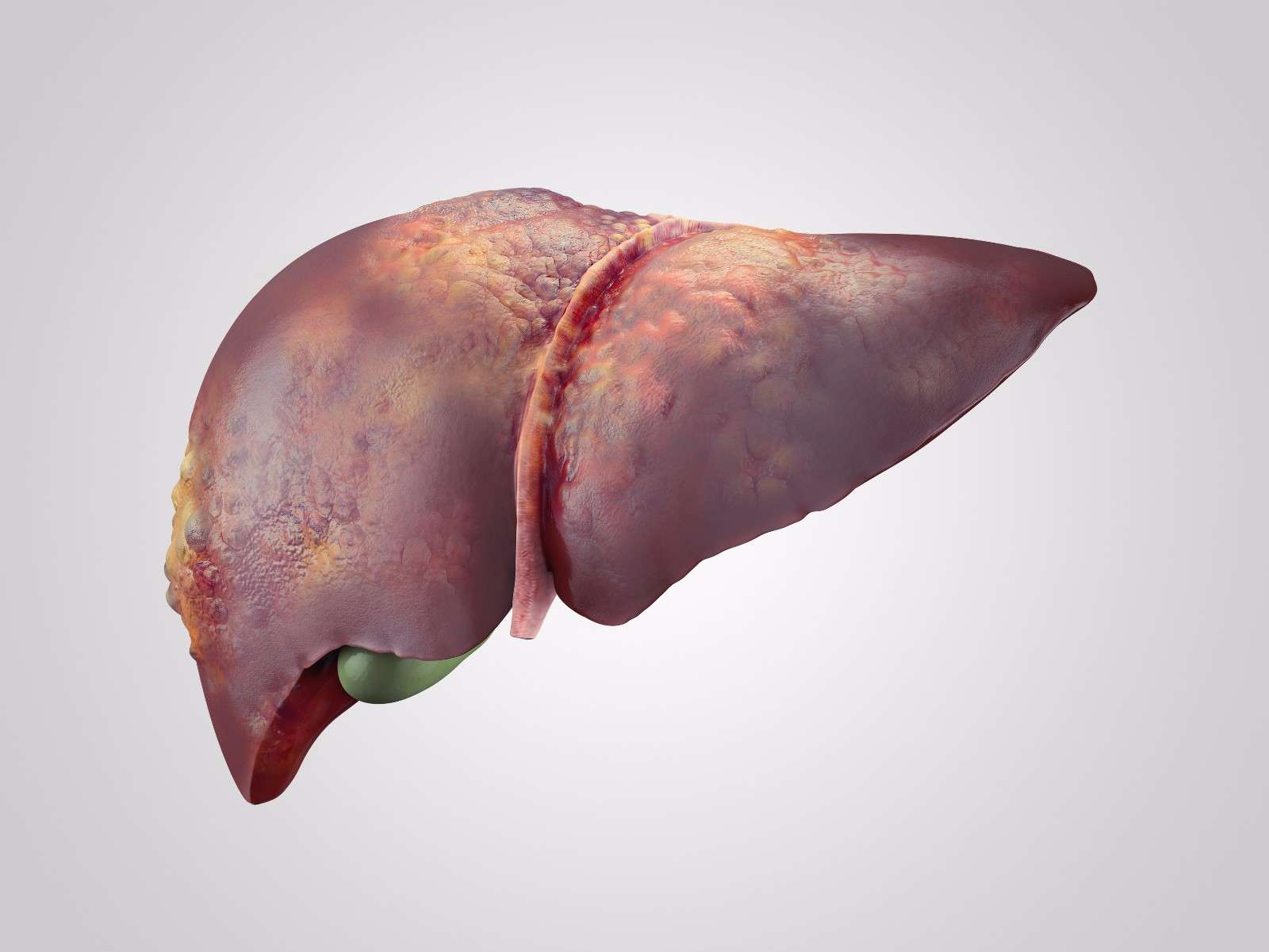 你了解原发性肝癌？提醒：患上这一疾病后，身体多半会有4个异常