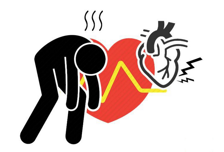 运动性猝死虽说突发,看似悄无声息,但并不意味着猝死来临时就没有一丝