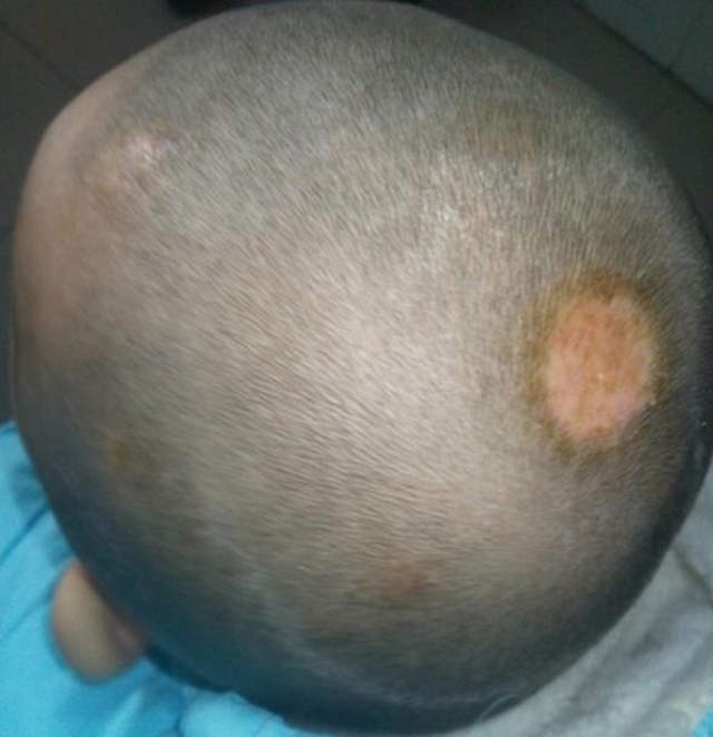 头癣中的黄癣由许兰毛癣菌感染引起;白癣主要由犬小孢子菌,石膏样小