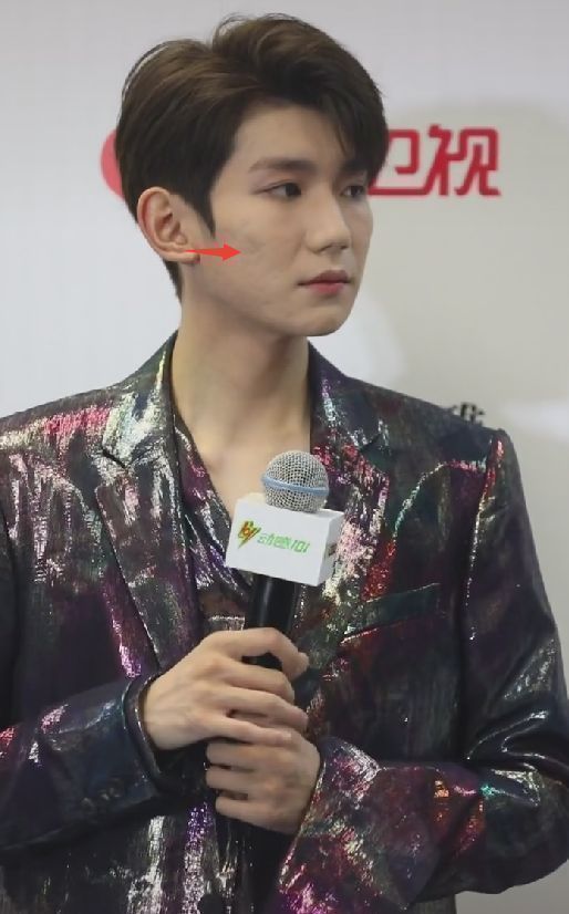 王源出席活动宣传新歌皮肤状态再引热议美颜都盖不住痘印