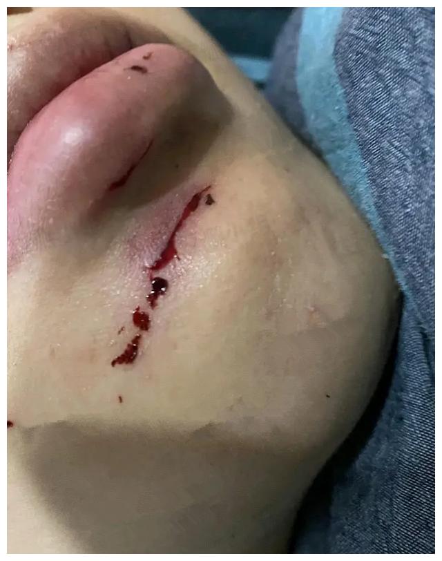 网曝范丞丞录节目出意外,下巴严重摔伤血直流,深夜紧急求助医生