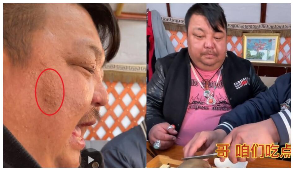 泡泡龙事件引起重视又一位千万网红脸上出现黑斑体重更夸张