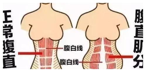 腹直肌分离主要是腹白线被撑大的,子宫在腹部的挤压拉伸不能回到原来