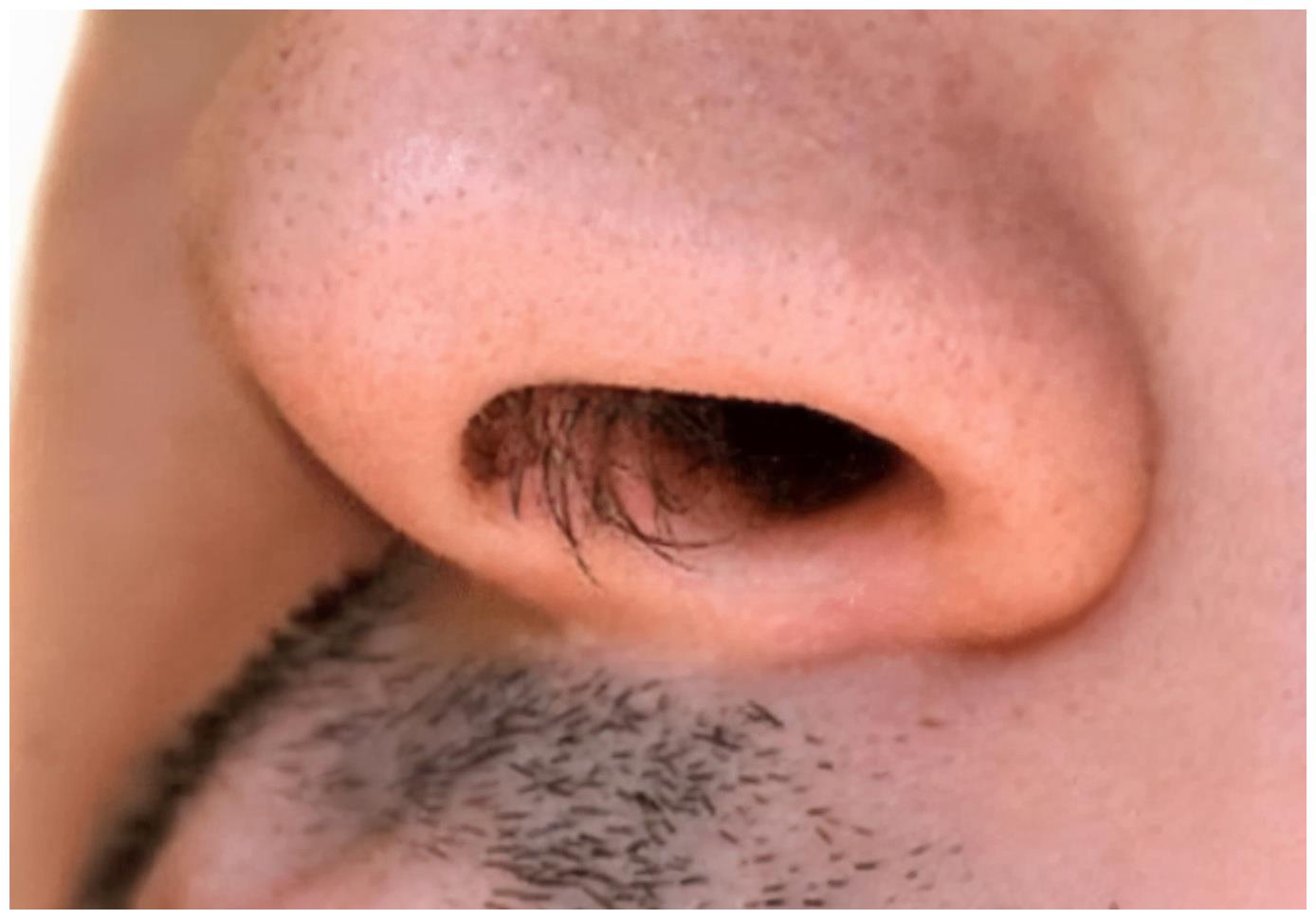 为何人到中年鼻毛总往外窜鼻毛生长速度快是身体出问题了吗