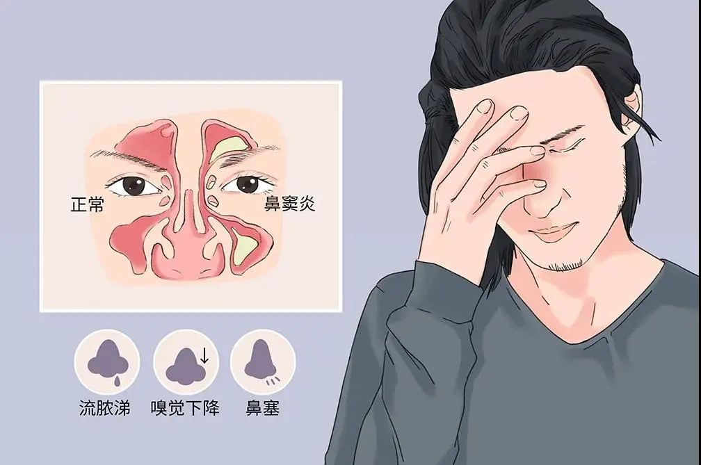 鼻炎耳贴的部位图片图片