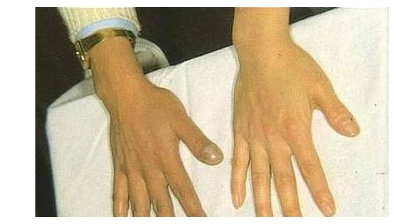 手上若无此种变化,肺保养的还可以|肺部|手指|大拇指_新浪新闻