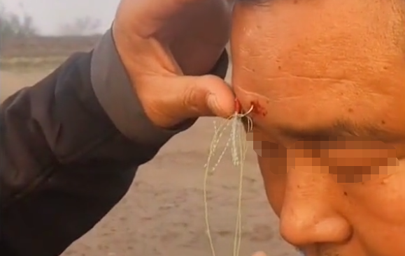 看着都疼,玩路亚虽快乐,做好防护太重要,钓到自己很痛苦休闲区蓝鸢梦想 - Www.slyday.coM 看着都疼,玩路亚虽快乐,做好防护太重要,钓到自己很痛苦休闲区蓝鸢梦想 - Www.slyday.coM