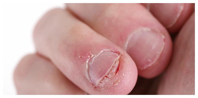 医生坦言:逃不开两种结局|咬指甲|指甲|家长_新浪新闻