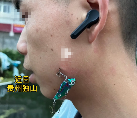 看着都疼,玩路亚虽快乐,做好防护太重要,钓到自己很痛苦休闲区蓝鸢梦想 - Www.slyday.coM 看着都疼,玩路亚虽快乐,做好防护太重要,钓到自己很痛苦休闲区蓝鸢梦想 - Www.slyday.coM