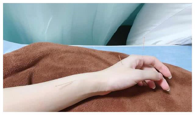 金莎参加姐姐综艺跳舞手四肢不协去针灸,满手银针让人心疼