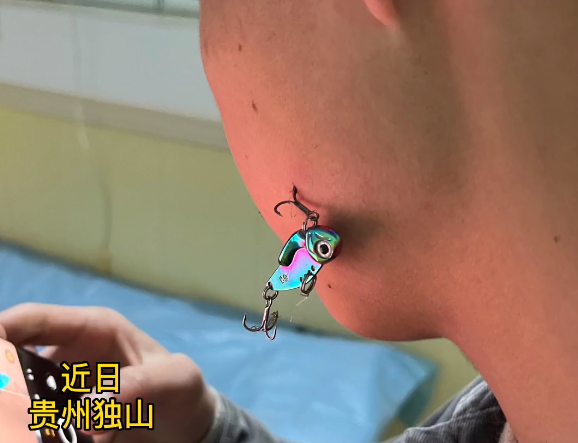 看着都疼,玩路亚虽快乐,做好防护太重要,钓到自己很痛苦休闲区蓝鸢梦想 - Www.slyday.coM 看着都疼,玩路亚虽快乐,做好防护太重要,钓到自己很痛苦休闲区蓝鸢梦想 - Www.slyday.coM