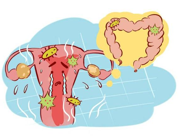 宫颈炎会癌变医生这种情况可发展成宫颈癌3大症状别忽视