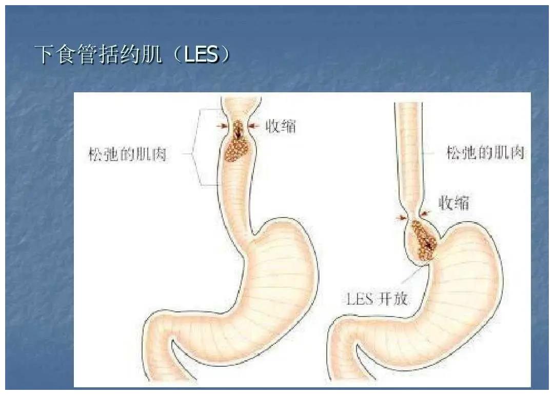 反流与贲门失弛缓症有关?医生为你详细解答