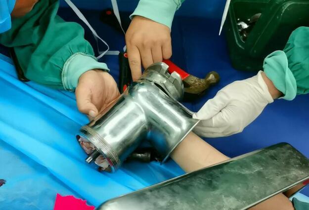16岁男孩手卷进绞肉机多根手指被绞烂