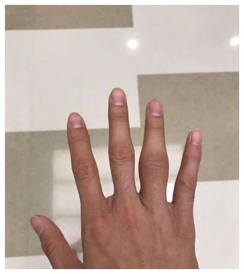工作室发受伤照:郭艾伦手指肿地像萝卜 腿部淤青!