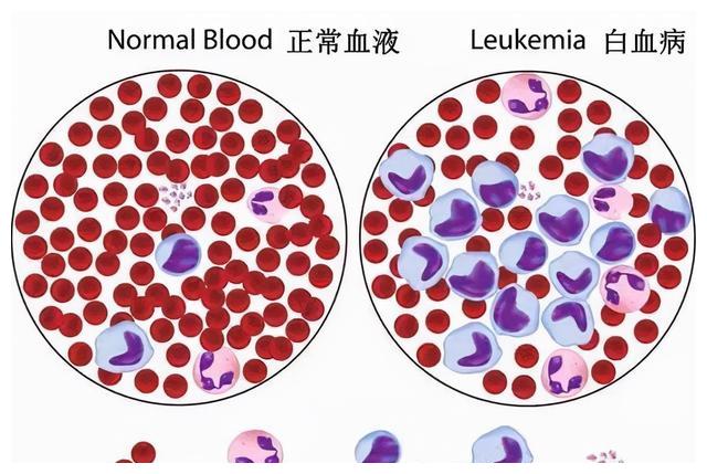 血液病|血小板|白血病_新浪新闻