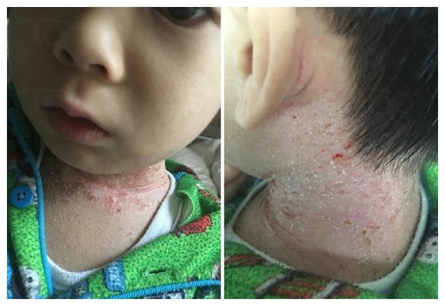 护士妈妈教7大方法预防,宝妈要学会|真菌|感染|皮肤瘙痒_新浪新闻