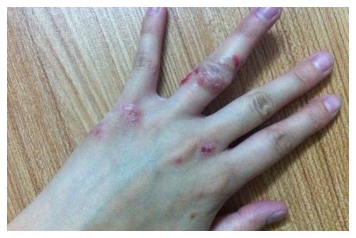 幼儿皮肤瘙痒脱皮或生癣护士妈妈教7大方法预防宝妈要学会