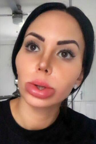 女子长得丑被人讽刺,花费190万元整容200次后,变成了香肠嘴