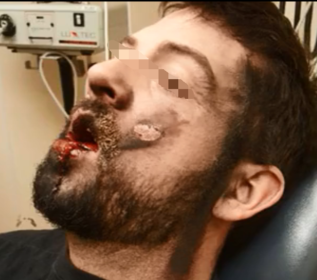 男子戒烟瘾抽电子烟不料电子烟易爆将牙炸掉嘴流血