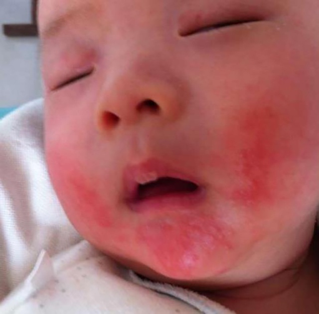 孩子湿疹从小就有 总反复咋办 平时应该注意啥