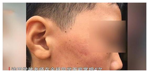 湖北一学生遭老师当全班面掌掴,学生脸肿胀发红,老师下手不轻