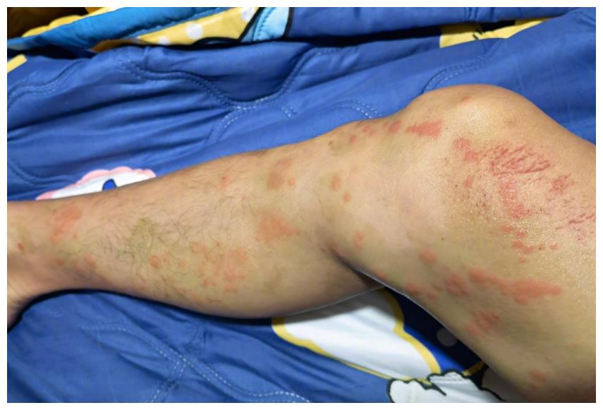 陈学冬被水母蜇伤大腿伤口密密麻麻一片红疤令人心疼