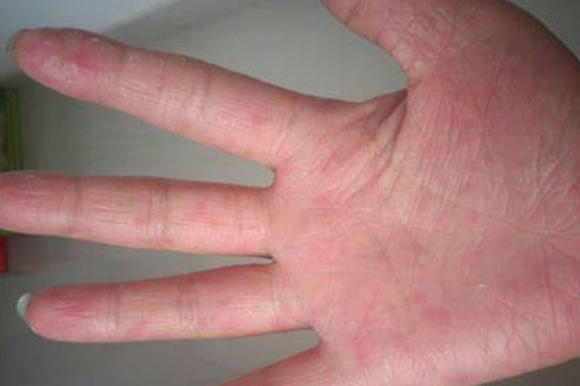 汗疱疹|水泡|湿气_新浪新闻