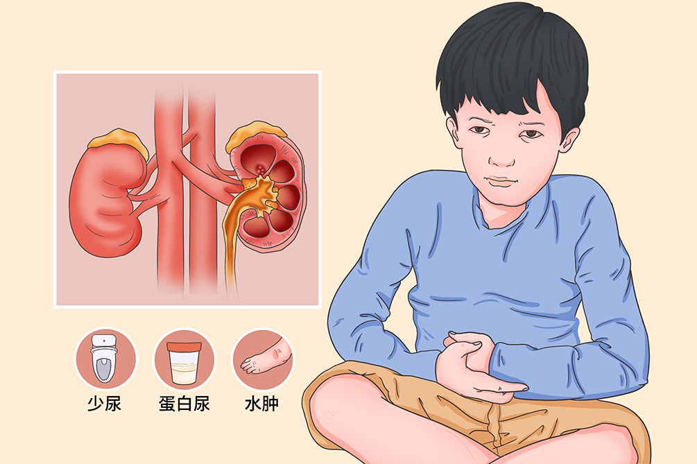 急性肾小球肾炎|预后|李玉斌_新浪新闻