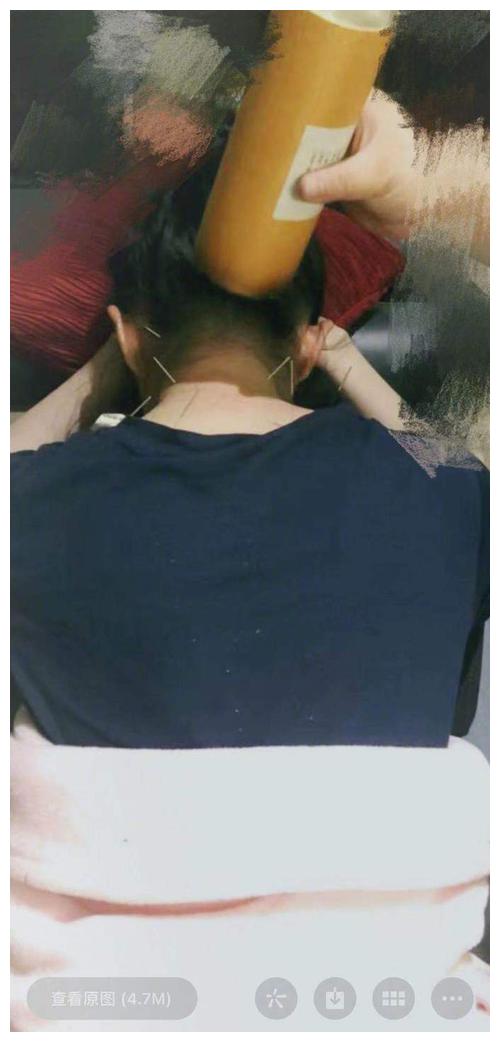 刘亦菲拍戏颈椎受伤做针灸是怎么回事 光是看一下就觉得很疼