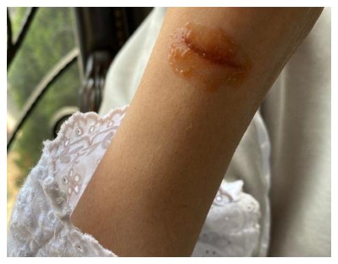 61岁倪萍下厨被烫伤,伤口红肿严重她却毫无知觉,竟还以为是颜料