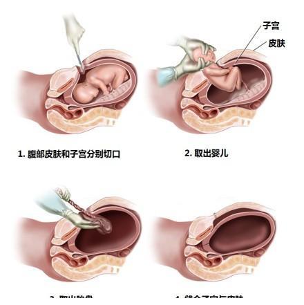 肠梗阻|产妇|剖腹产_新浪新闻
