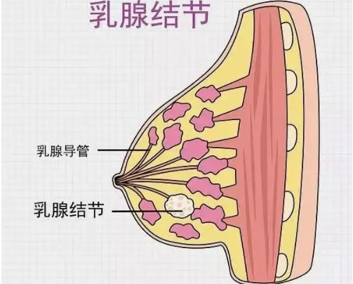 查出乳腺结节要远离豆腐医生3种零嘴才应该少碰