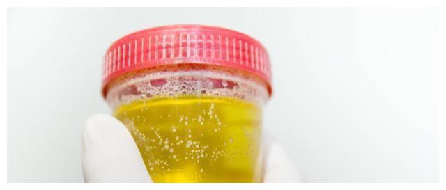 如果在早起以后出现尿液颜色发黄且带有泡沫的现象,则代表体内的毒素