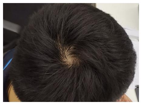 头发旋多脾气坏?和旋少相比,确实会多出两种烦恼