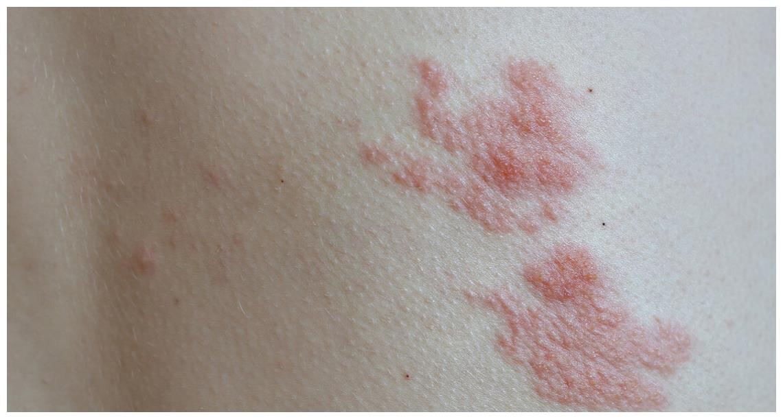 嘴上老是长疱疹 是怎么回事 嘻嘻嘴唇起泡 是什么原因