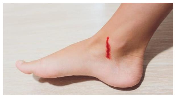 正常情况下,如果脚部受伤出血了,简单处理之后几天伤口就能愈合,但是