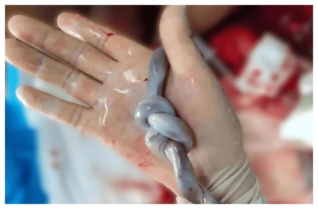 惊险!胎儿脐带罕见套环式双真结,吓坏接产医生:想想就一阵后怕