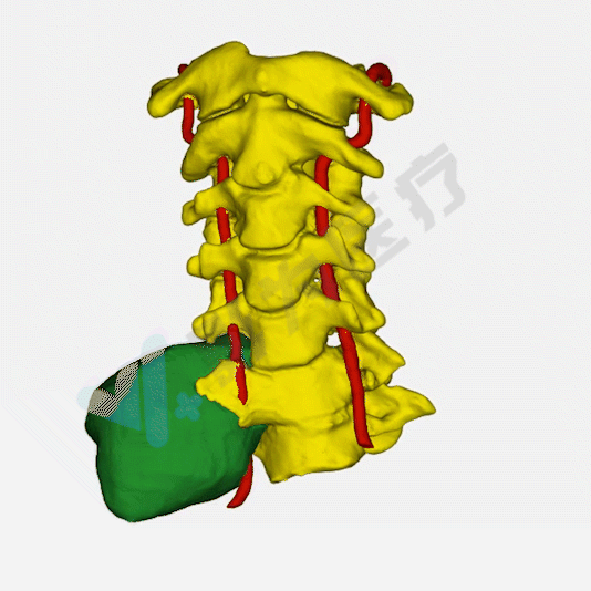 3d打印|医疗|颈椎_新浪新闻
