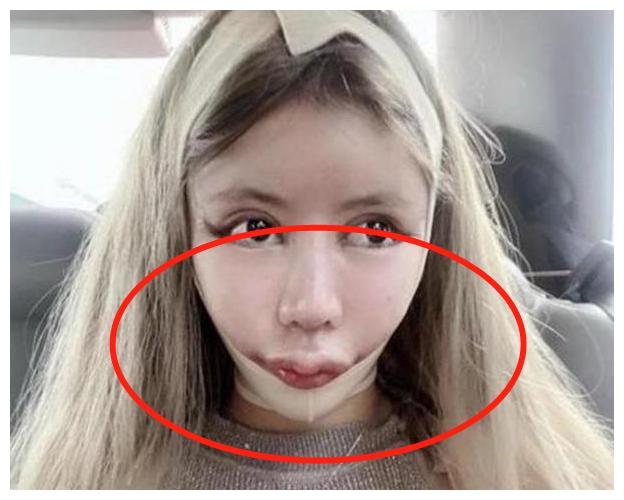 13岁女孩沉迷整容3年间花近百万整了60次网友不如不整