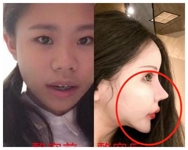 13岁女孩沉迷整容3年间花近百万整了60次网友不如不整